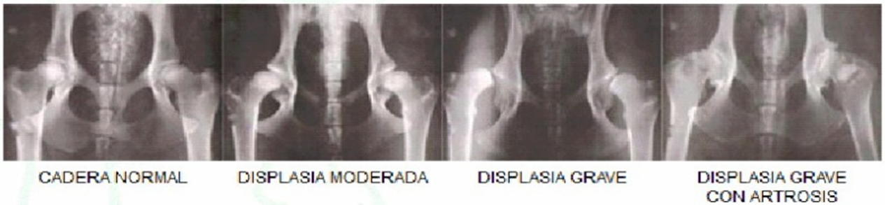 Dislapsia de caderas - Radiografías